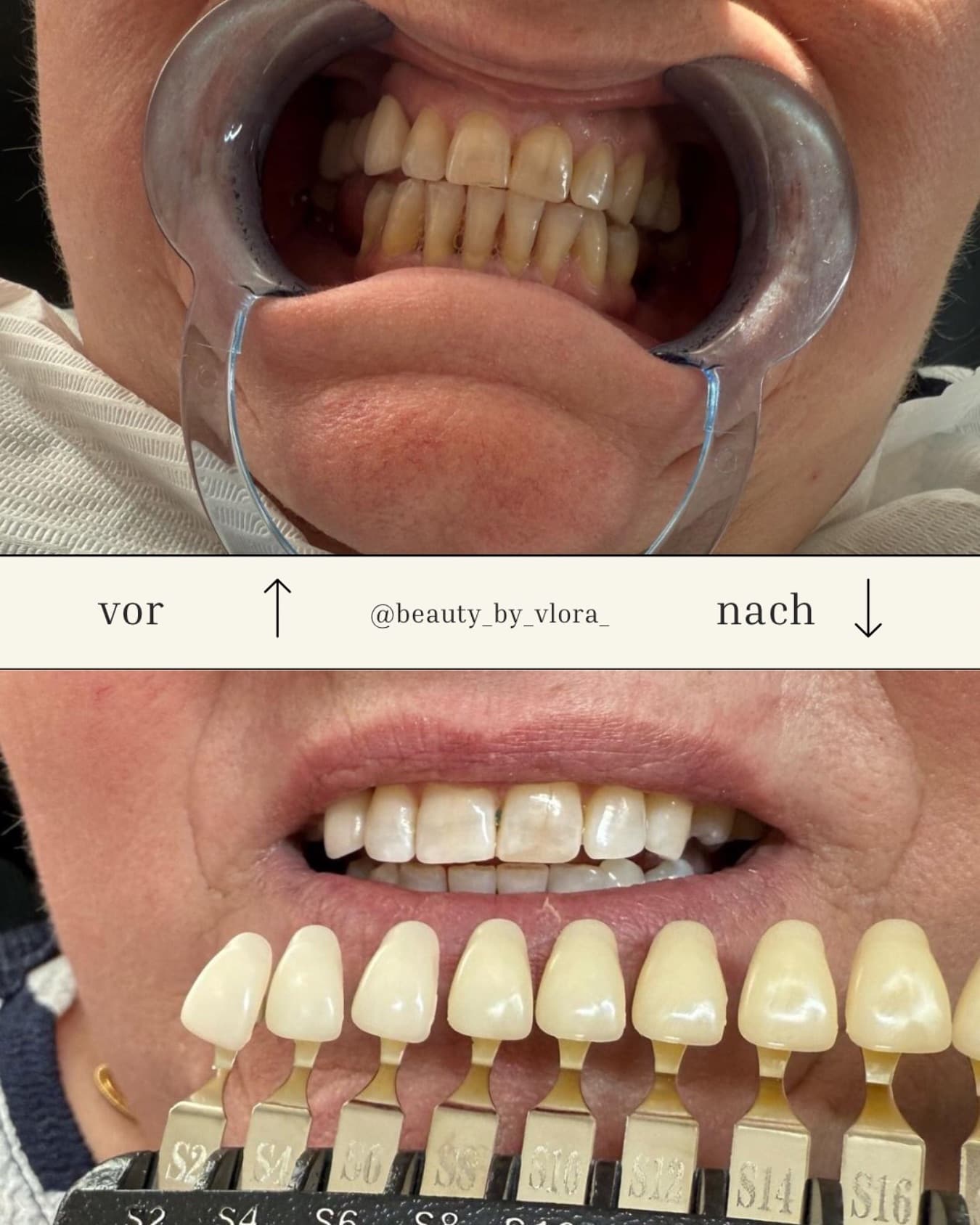 Professionelles Smile Refinement — Ergebnis